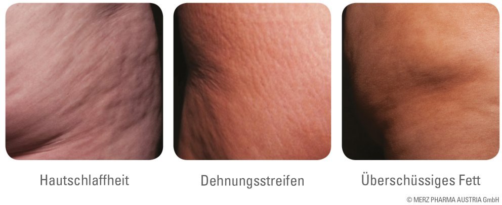 Die Ursachen von Cellulite Die Ursachen von Cellulite