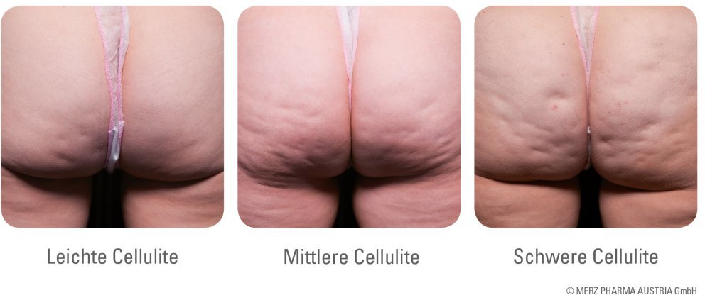 Arten der Cellulite