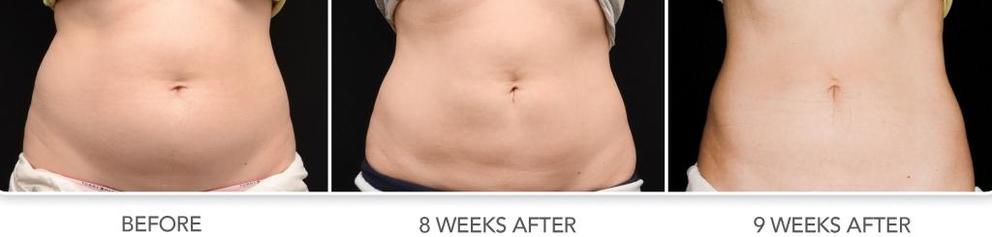 Ergebnis nach zweimaliger Anwendung von Cool Sculpting Ergebnis nach zweimaliger Anwendung von Cool Sculpting