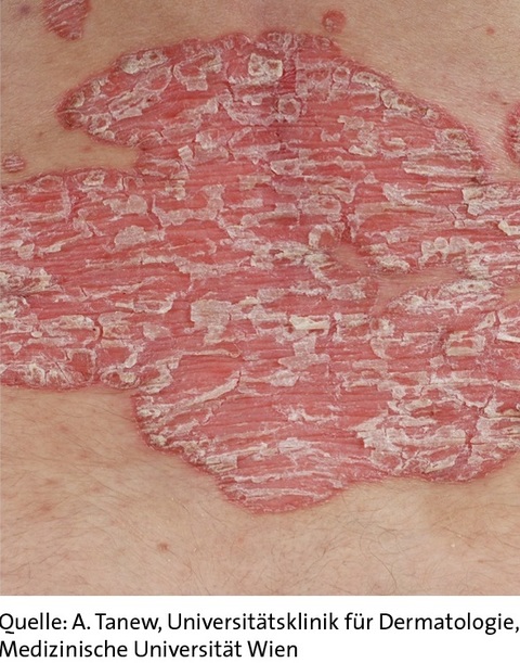 Abbildung Psoriasis Abbildung Psoriasis