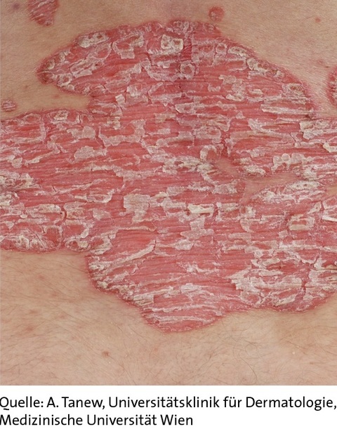 Abbildung Psoriasis