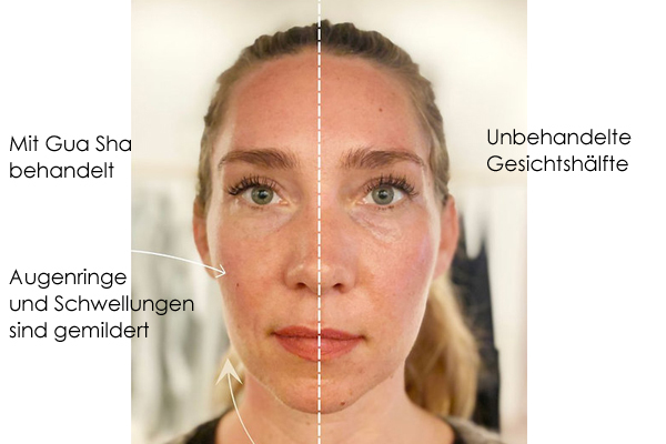 Eine Gesichtshälfte wurde mit Gua Sha behandelt, die andere blieb unbehandelt. 