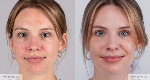 Geschwächte oder sogar kranke Haut benötigt in erster Linie eine wohltuende, regenerierende und stärkende Behandlung, die sie wieder ausgleicht, optimal versorgt und strahlen lässt Geschwächte oder sogar kranke Haut benötigt in erster Linie eine wohltuende, regenerierende und stärkende Behandlung, die sie wieder ausgleicht, optimal versorgt und strahlen lässt